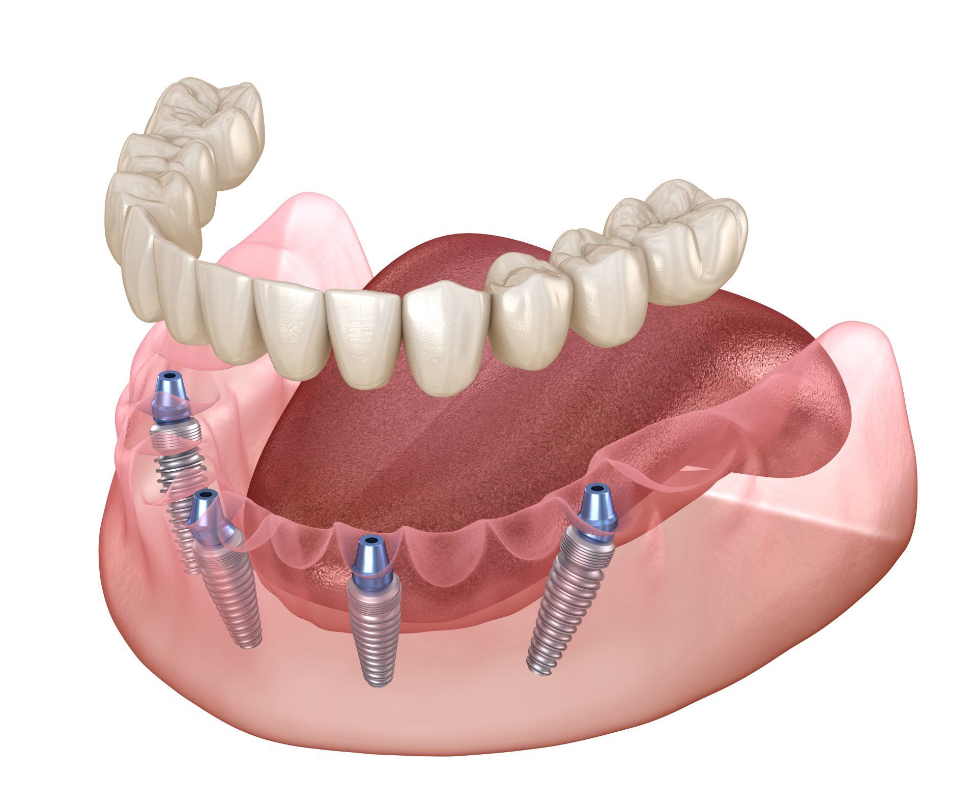 Full arch Implant Solutions
