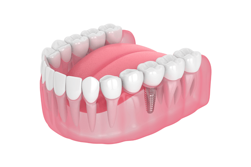 Implant Restorations