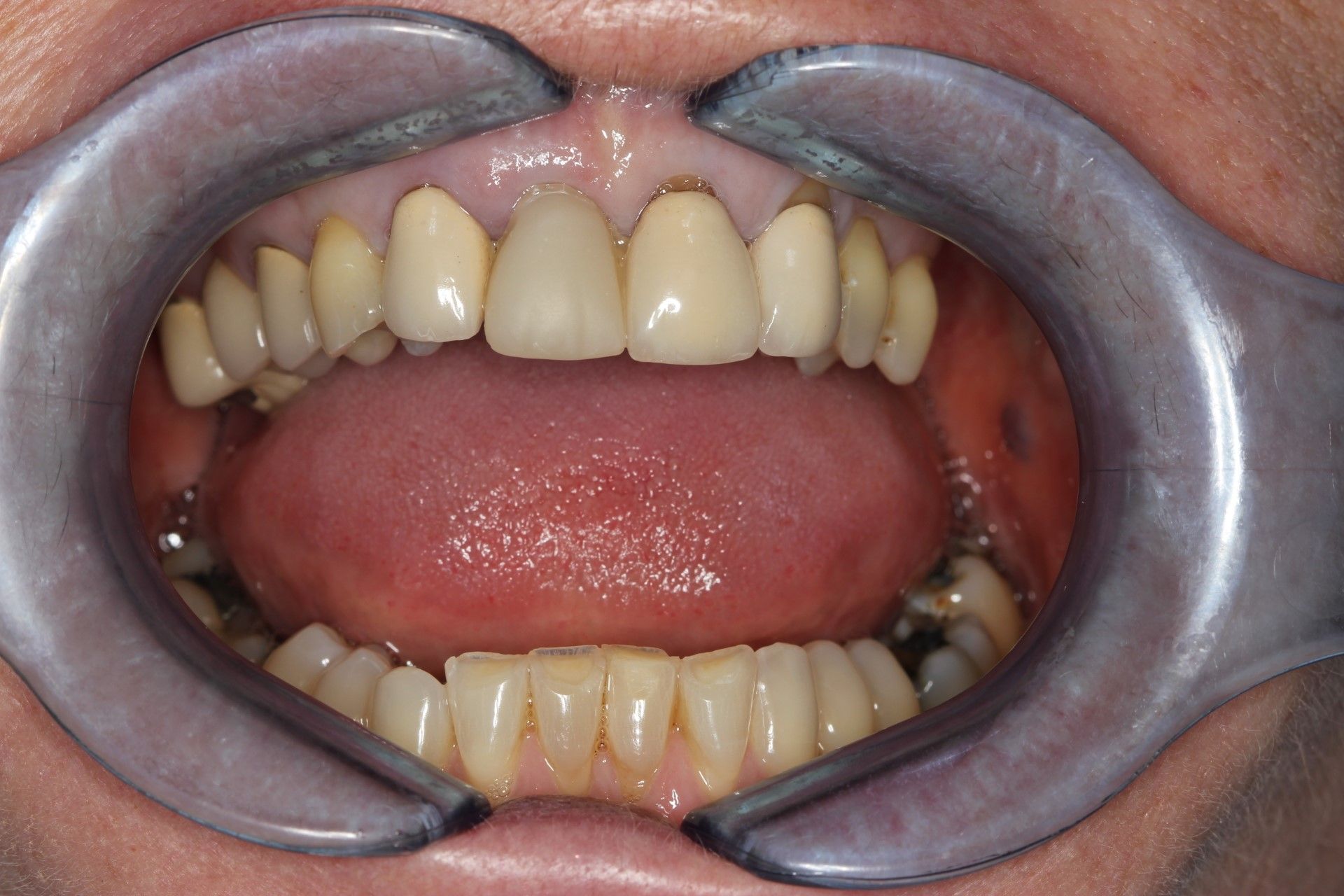 A close up of a person 's mouth with a dental mirror and retractors. Patient has dental crowns