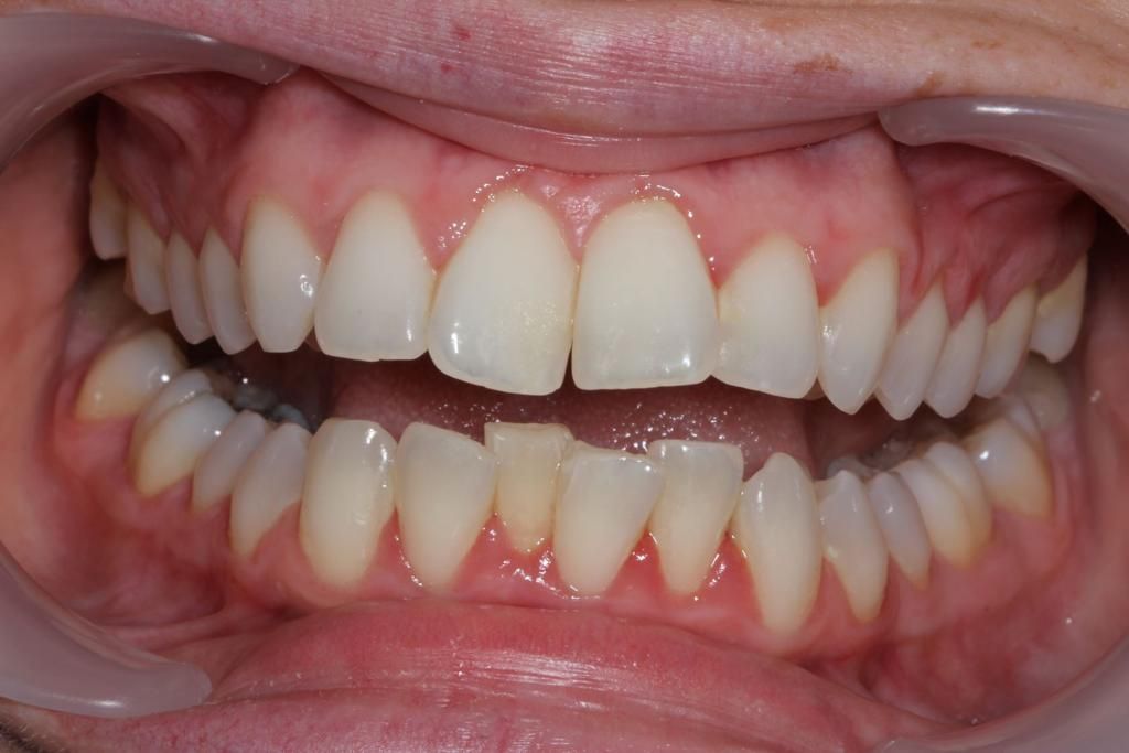 A close up of a person 's misalign, crooked teeth. 