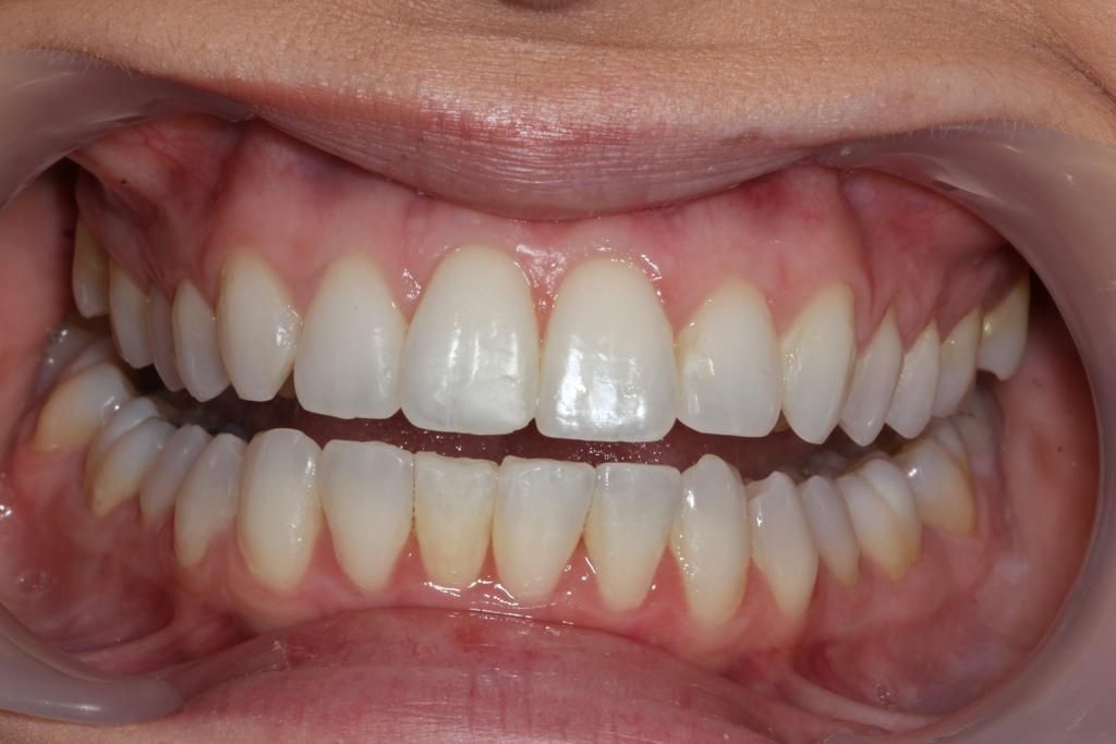 A close up of a person 's teeth with white teeth. Invisible braces, Invisalign treatment, removable braces 
