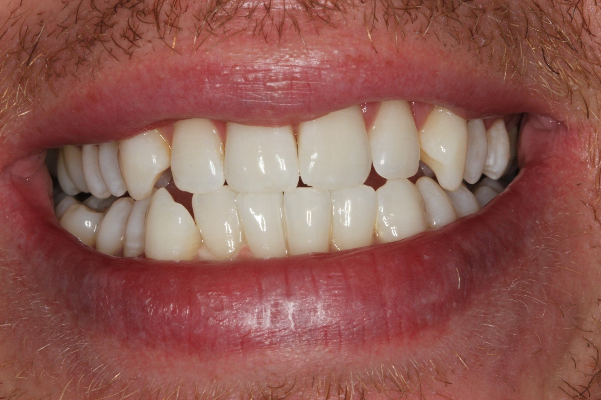 A close up of a man 's teeth with a beard. tee