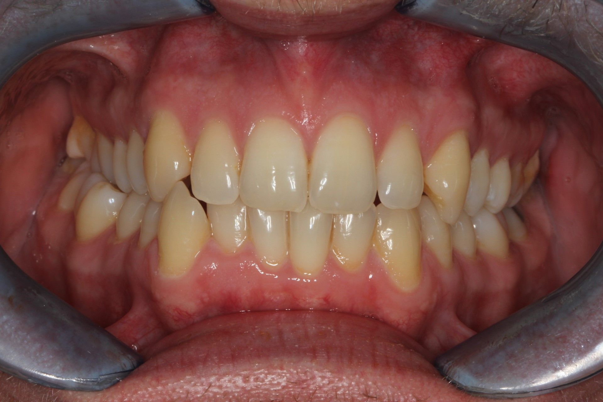 A close up of a person 's teeth with a mouth guard. Stained and discoloured teeth