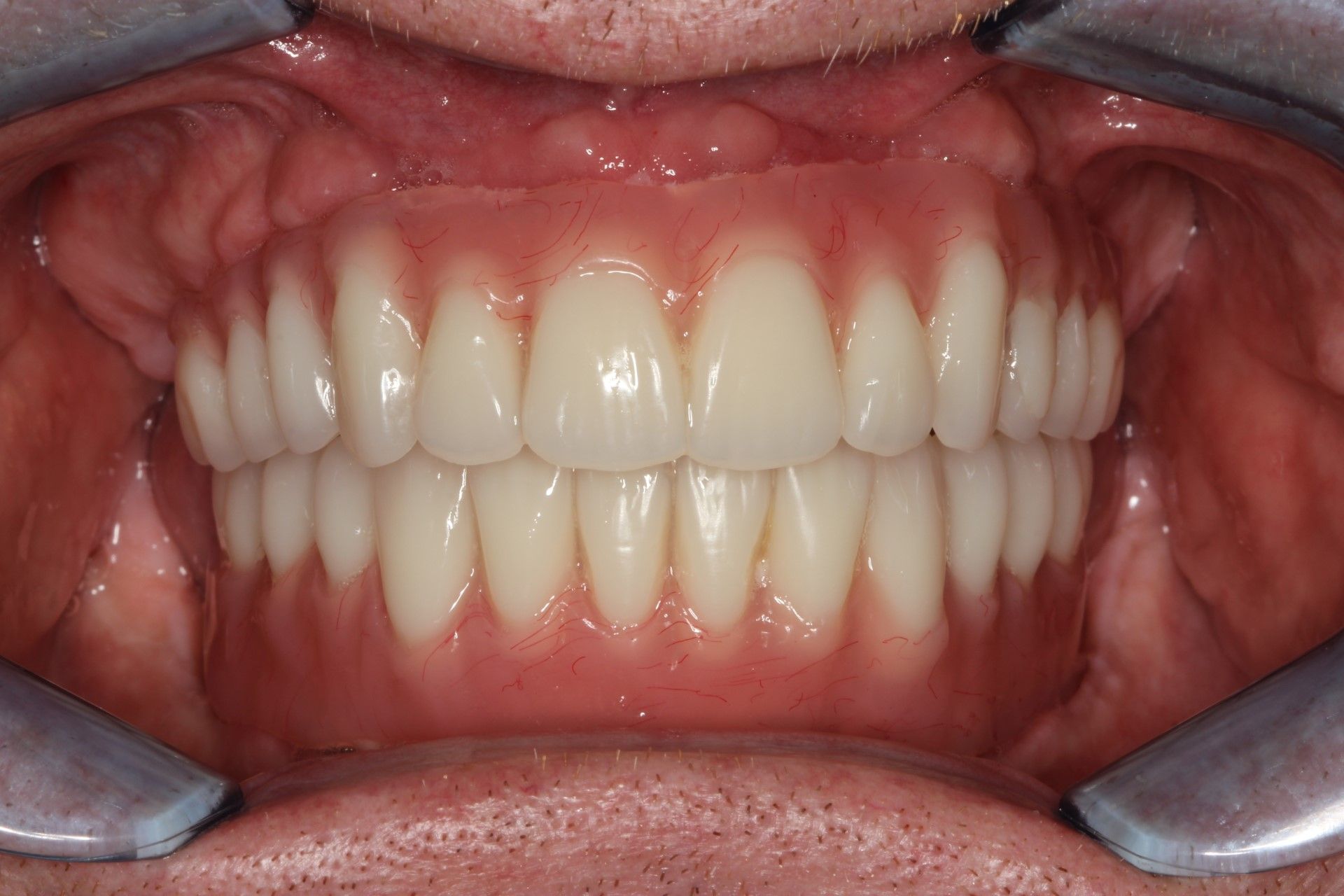 Healthy Smile, with dental implants, full mouth rehabilitation, all-on-4 concept