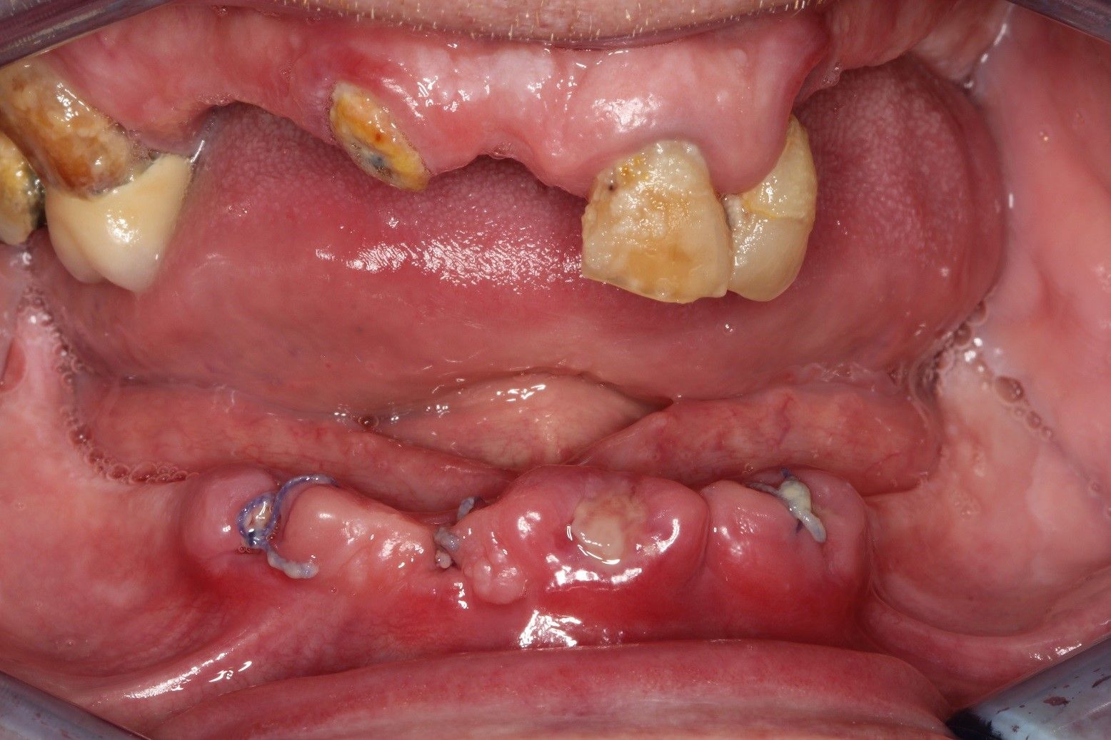 Image of a persons mouth, with missing teeth.