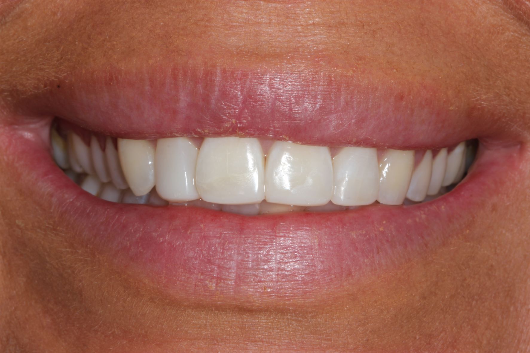 A close up of a woman 's smile with white teeth.