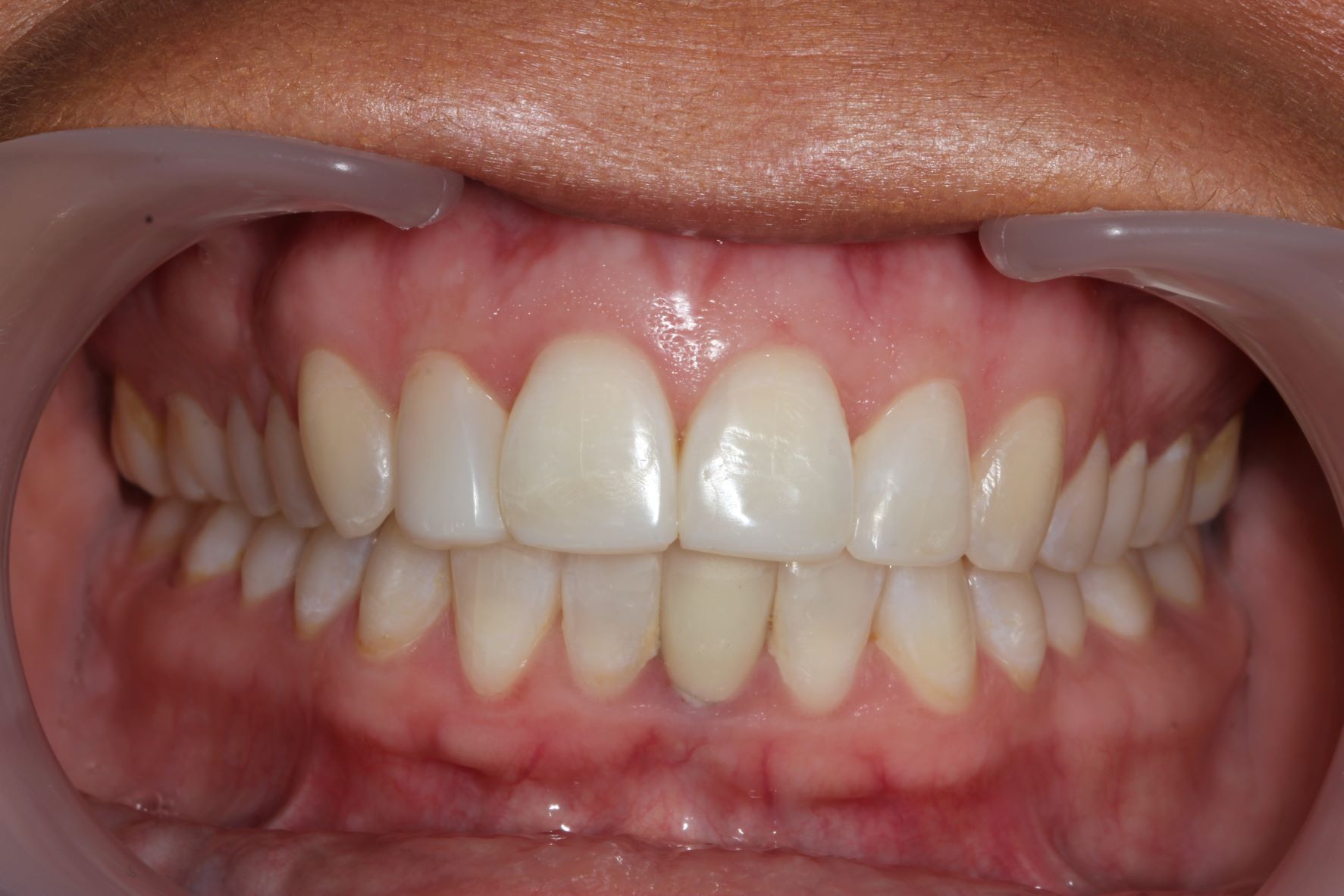 A close up of a person 's straight and white smile. Clear braces, removable braces, Invisalign treatment performed.