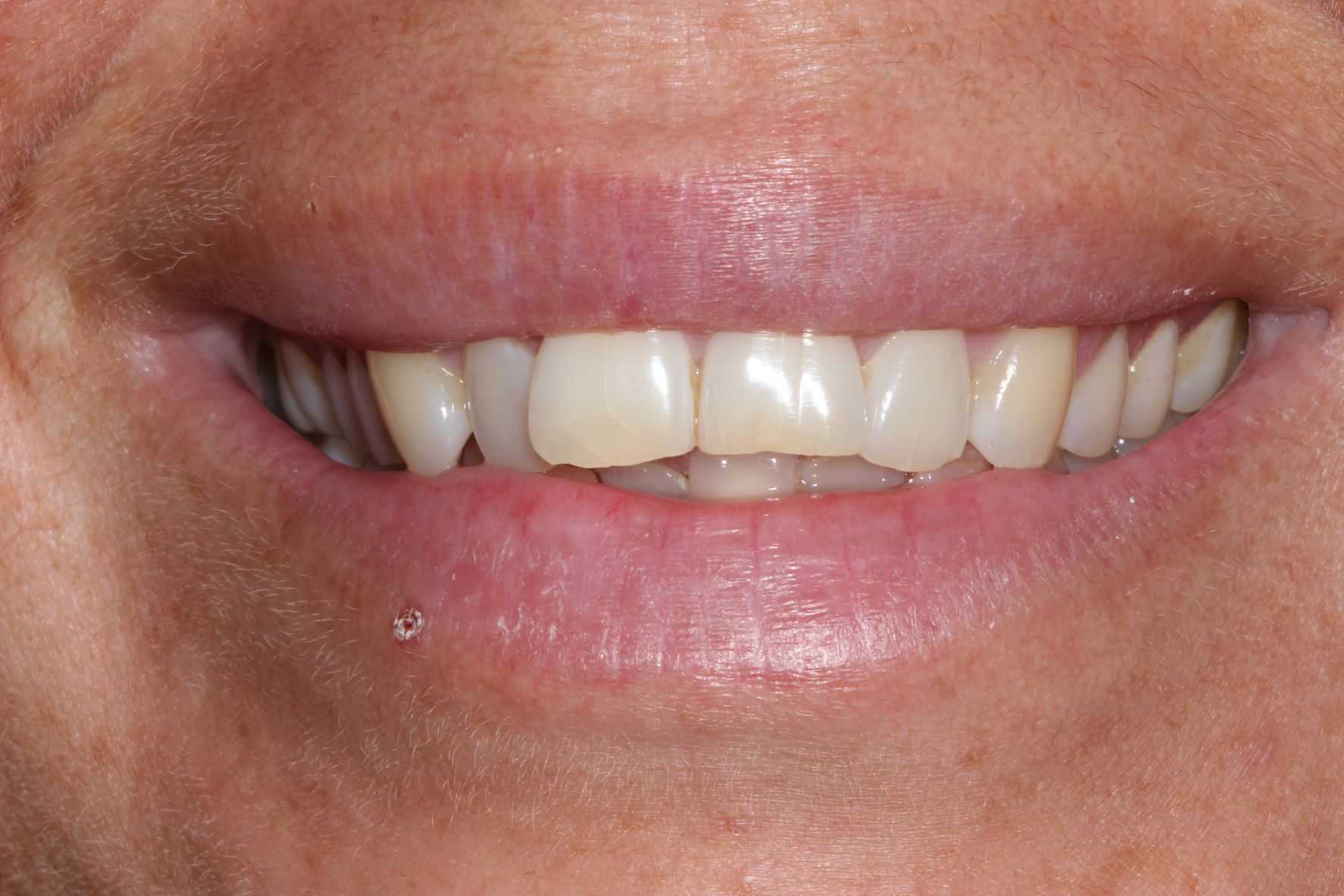 A close up of a woman 's crooked, misaligned smile