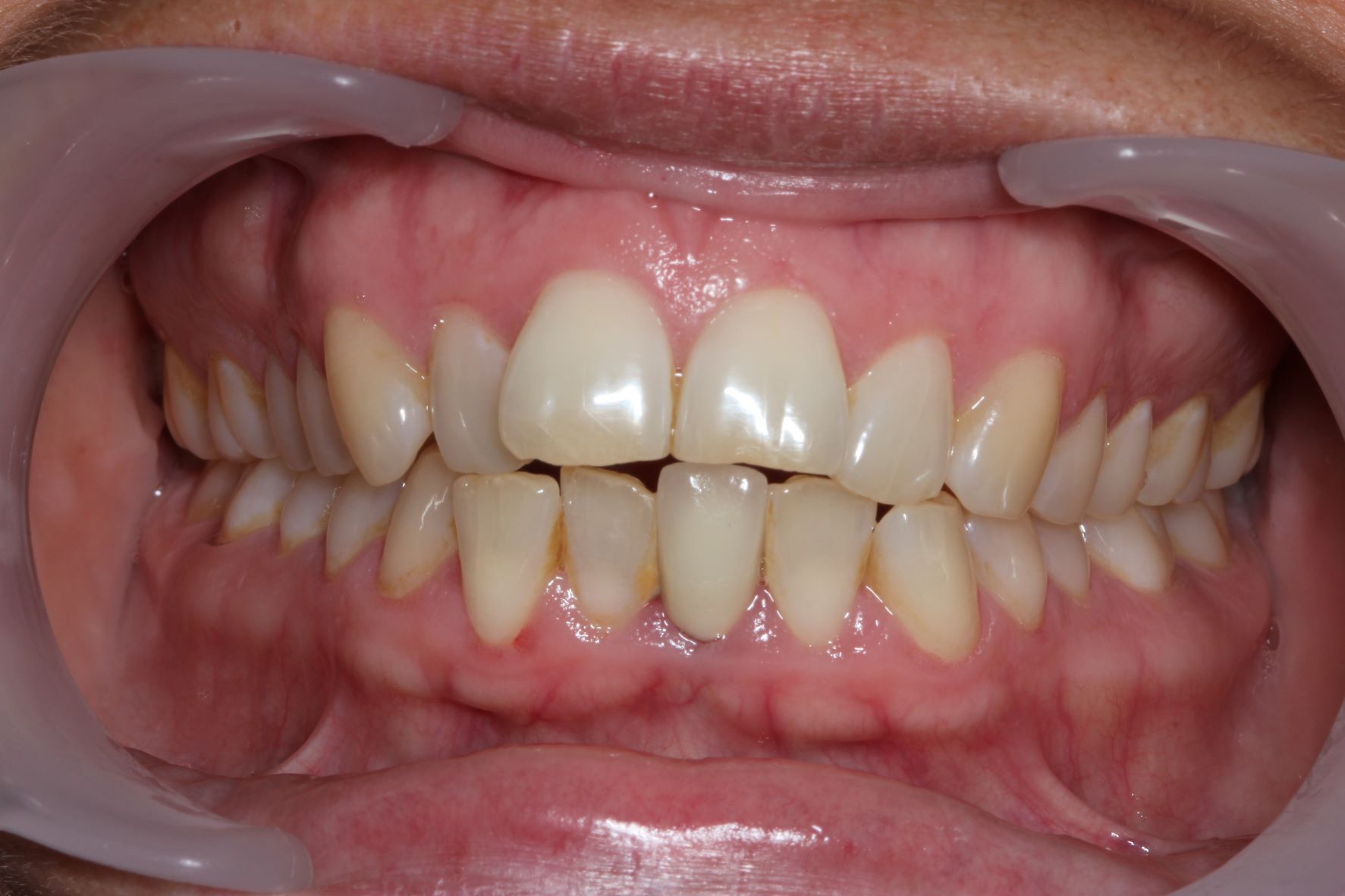 A close up of a person 's teeth. The teeth are misaligned and crooked. 