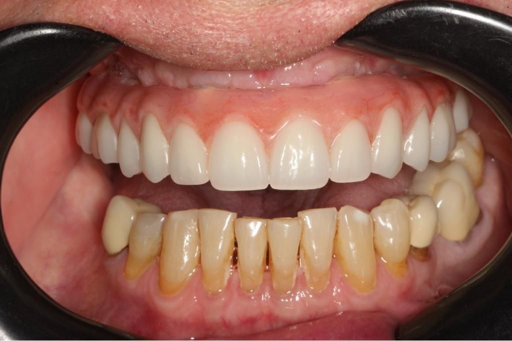 A close up of a person 's teeth, person has had dental implants
