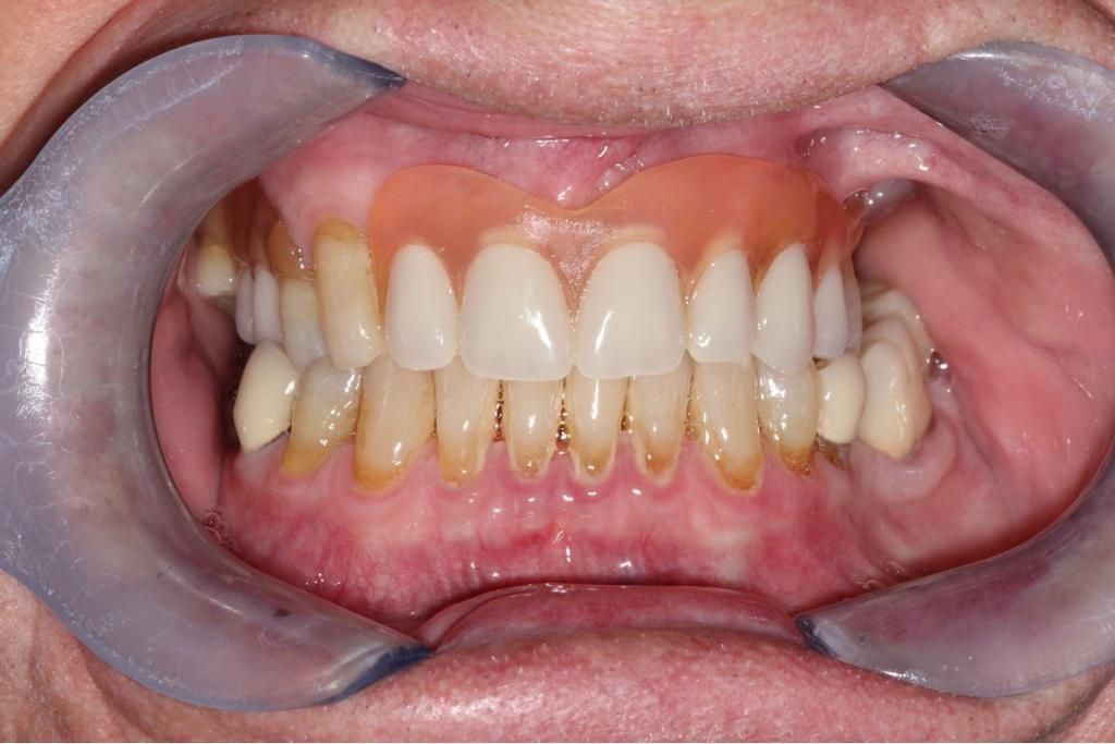 A close up of a person 's teeth with a denture