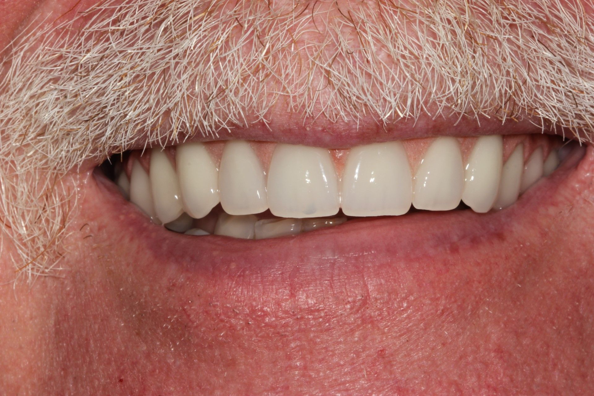 A close up of a man 's mouth with white teeth and a beard. Dental Implants, full arch rehabilitation.  