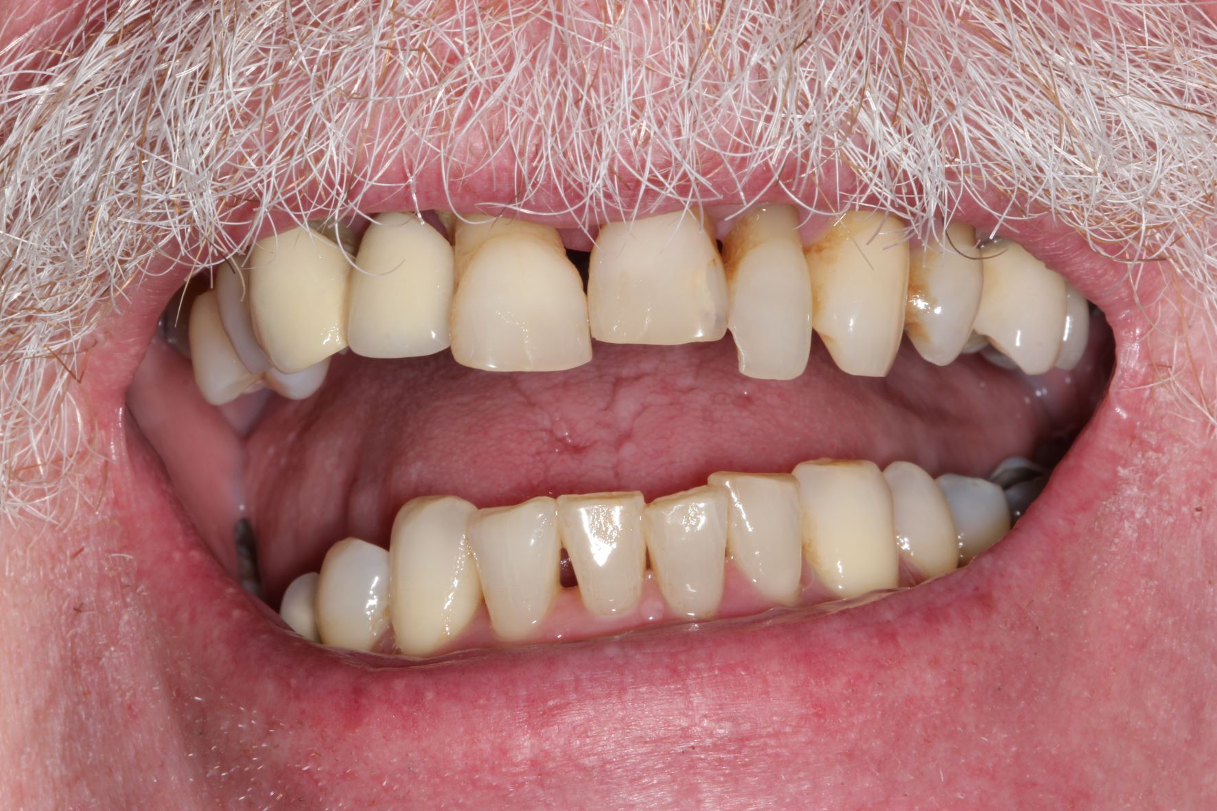 A close up of a man 's teeth with a beard.