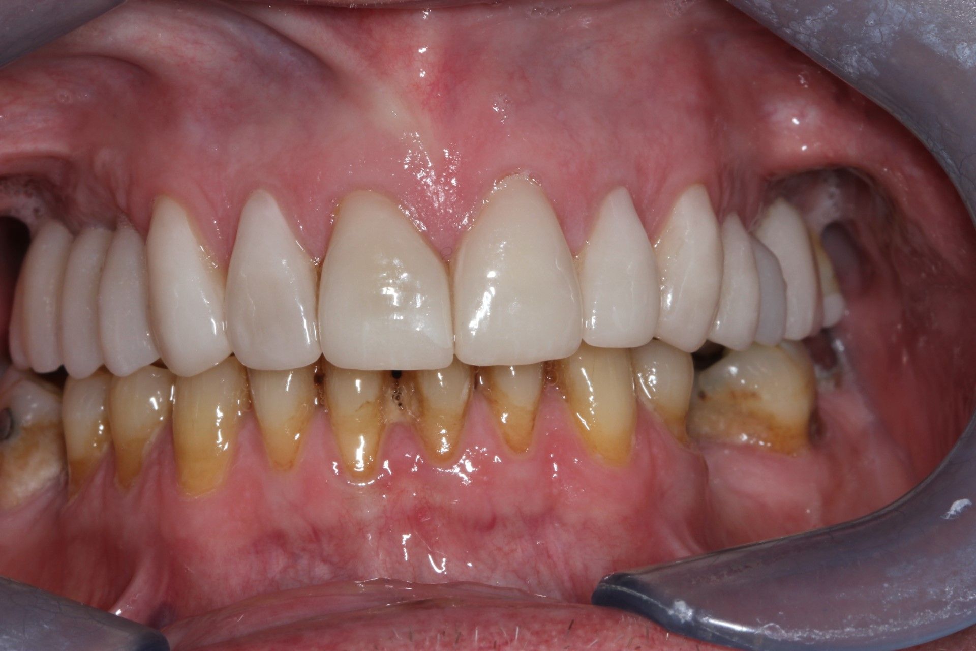 A White smile, a combination of crowns and dental implants