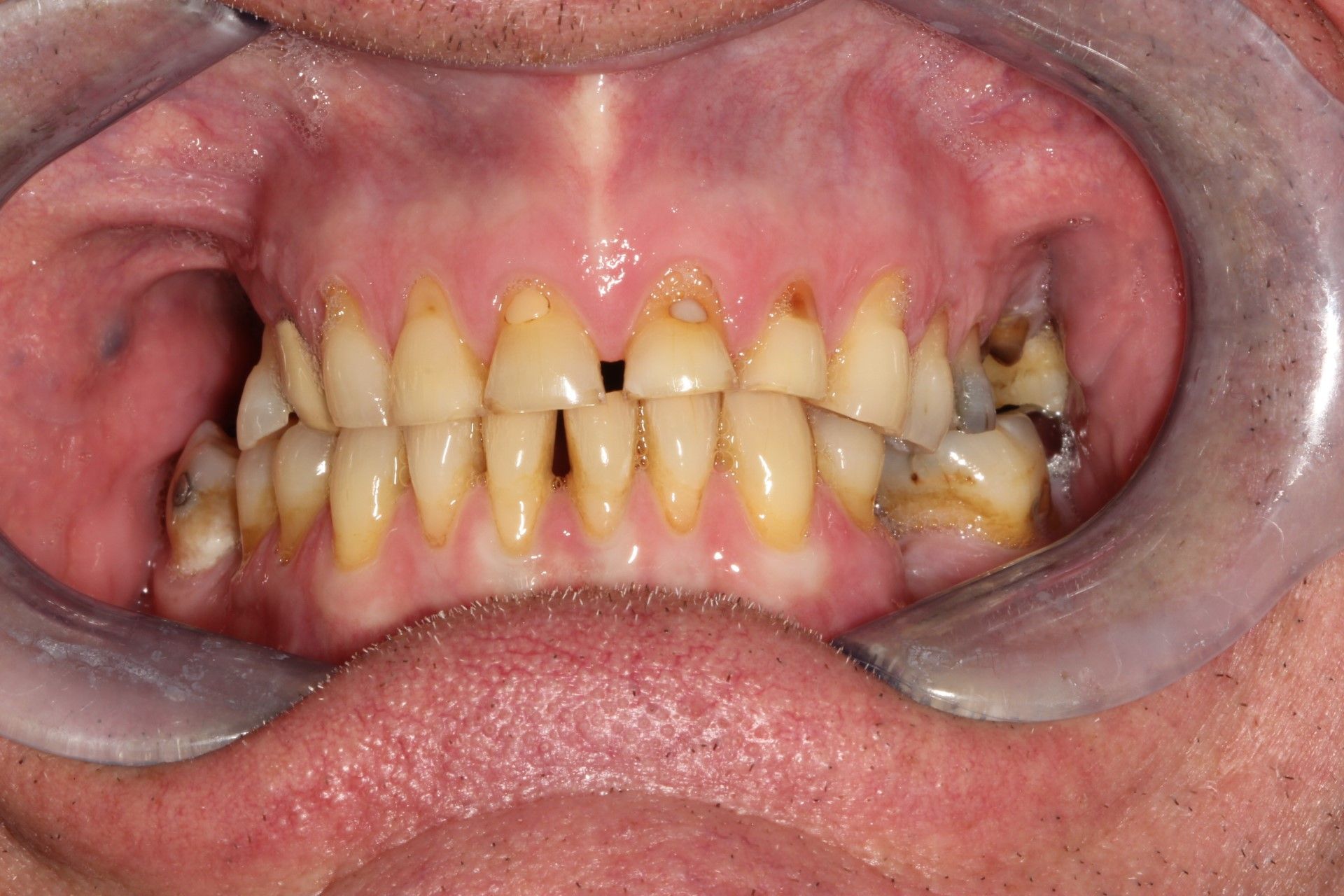 A close up of a person 's mouth, cavities and gum diesease