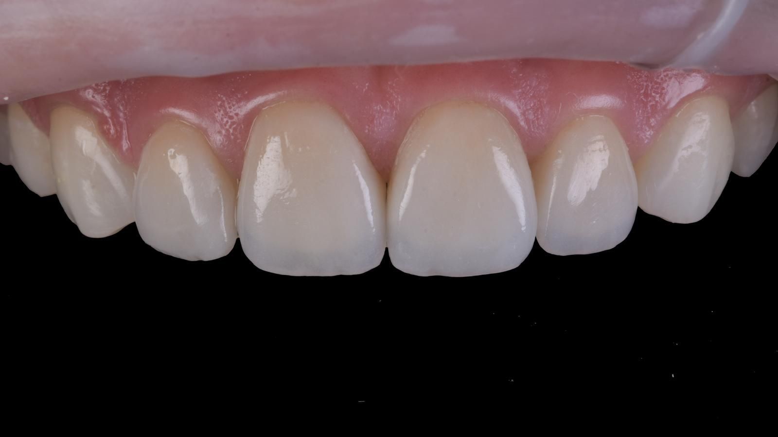 A close up of a person 's teeth on a black background. Teeth Whitening and composite bonding to create a symmetrical smile. 