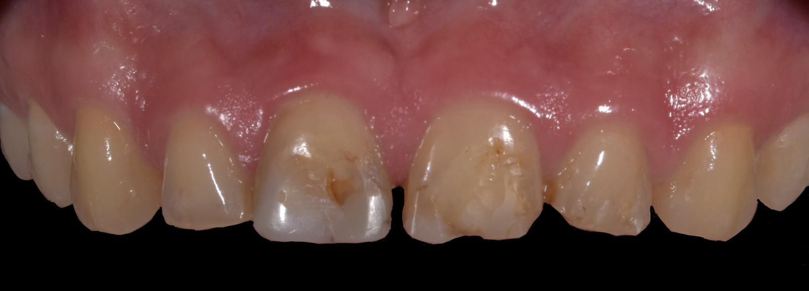 A close up of a person 's eroded and mottled teeth. The teeth and discoursed and stained. 