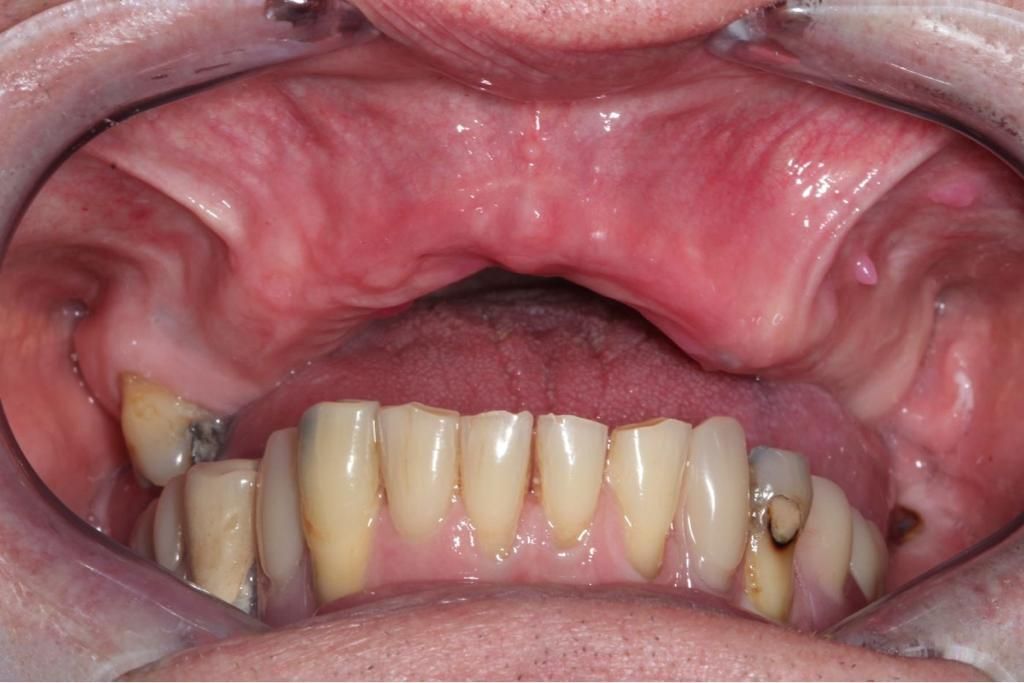 A close up of a person 's mouth with missing teeth. denture wearer
