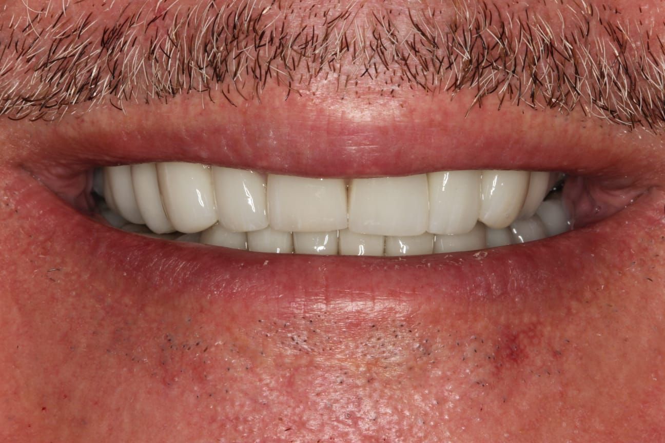 A close up of a man 's mouth with white teeth and a beard. Teeth Whitening, dental crowns and dental veneers and implants