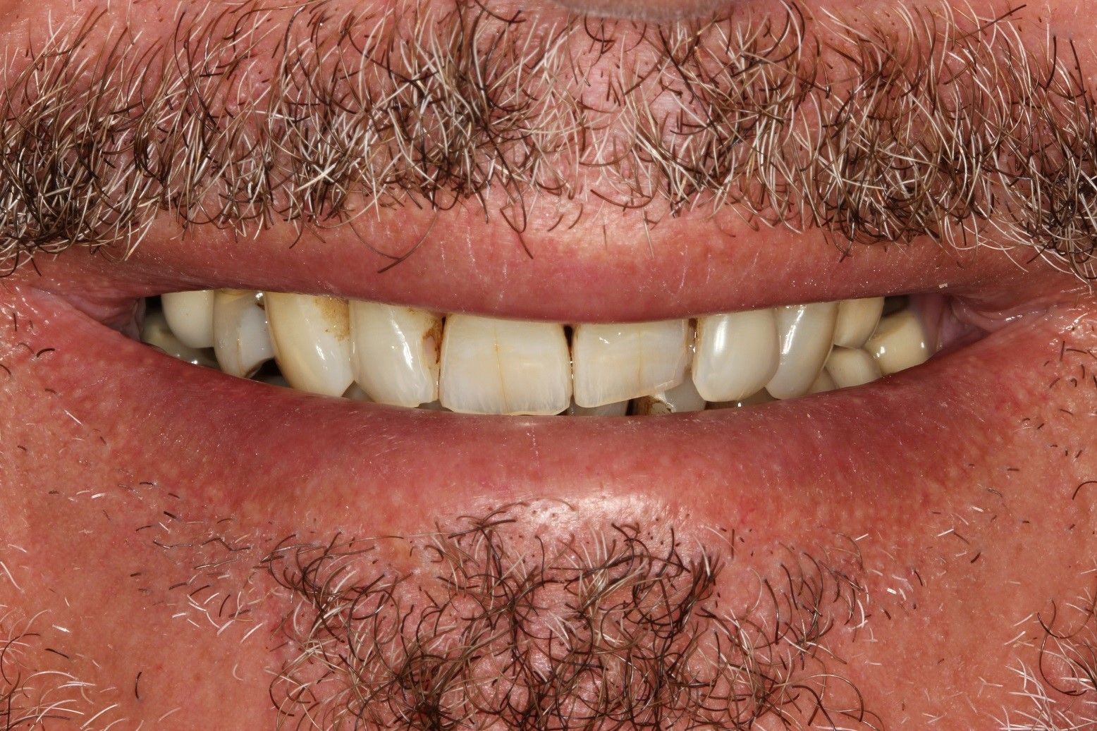 A close up of a man 's mouth with a beard and teeth