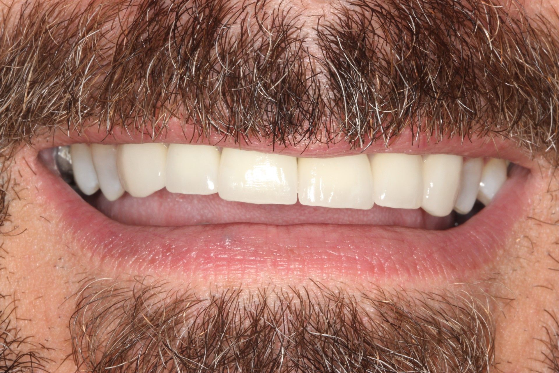 A close up of a man 's mouth with a beard and white teeth. Dental crowns and dental veneers and dental implants.  