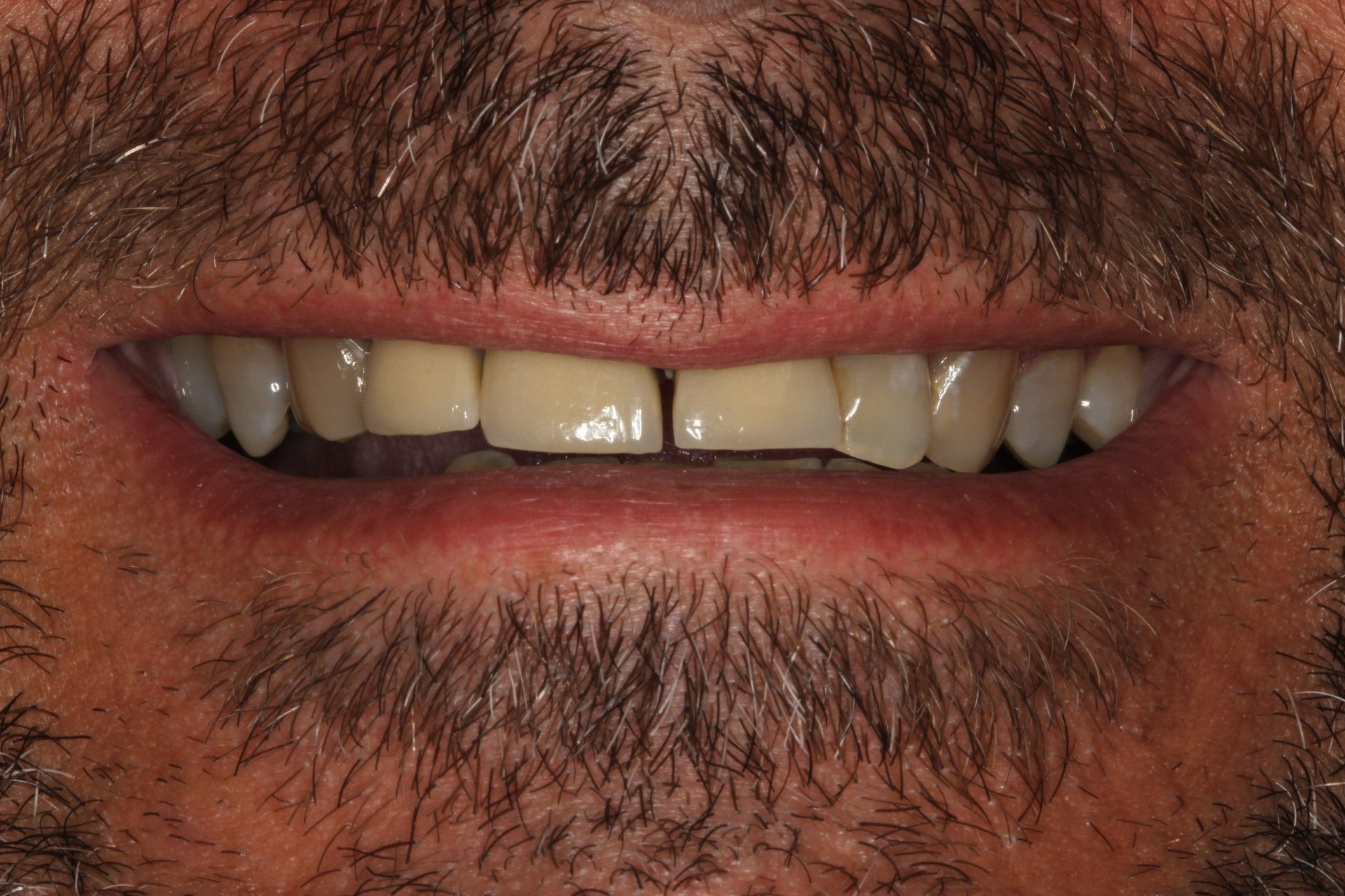 A close up of a man 's mouth with a beard and teeth.