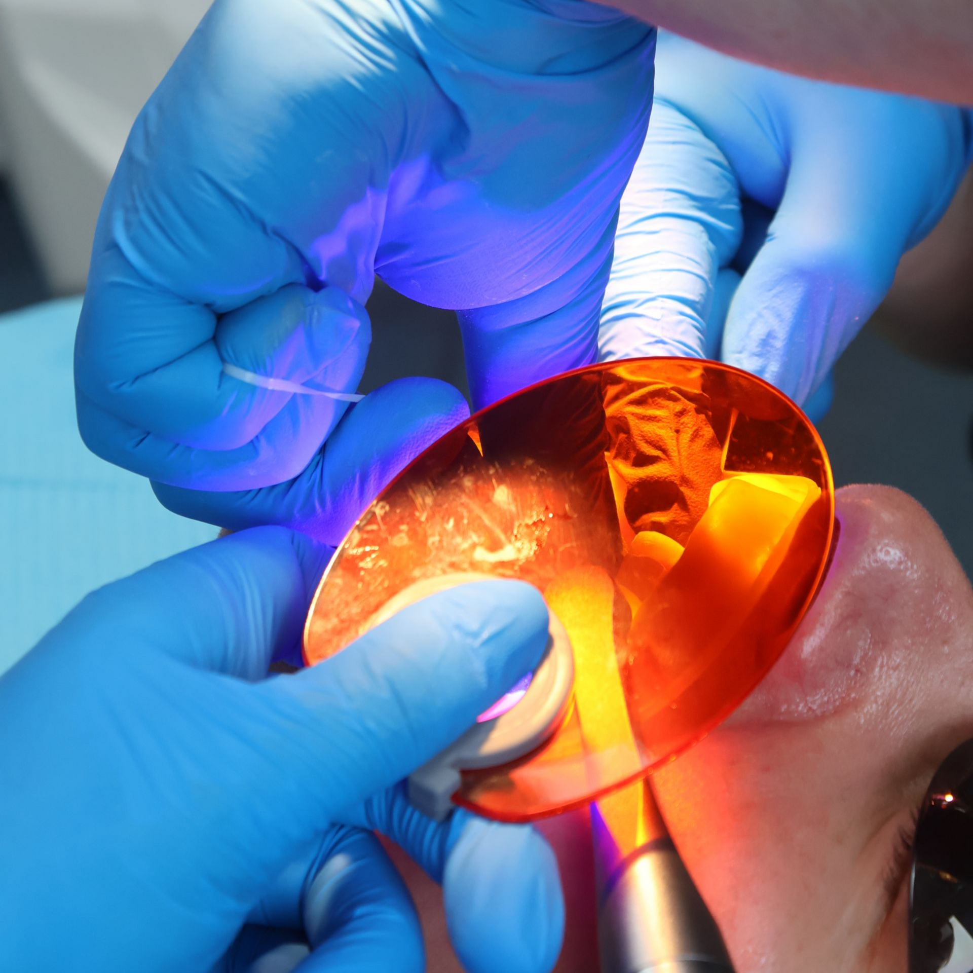 Composite bonding treatment at Newton Dental, Newton-le-Willows. 