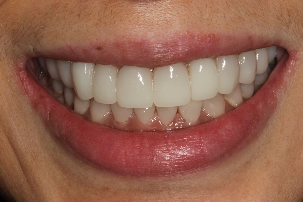 dent veneers, newton-le-willows, newton dental