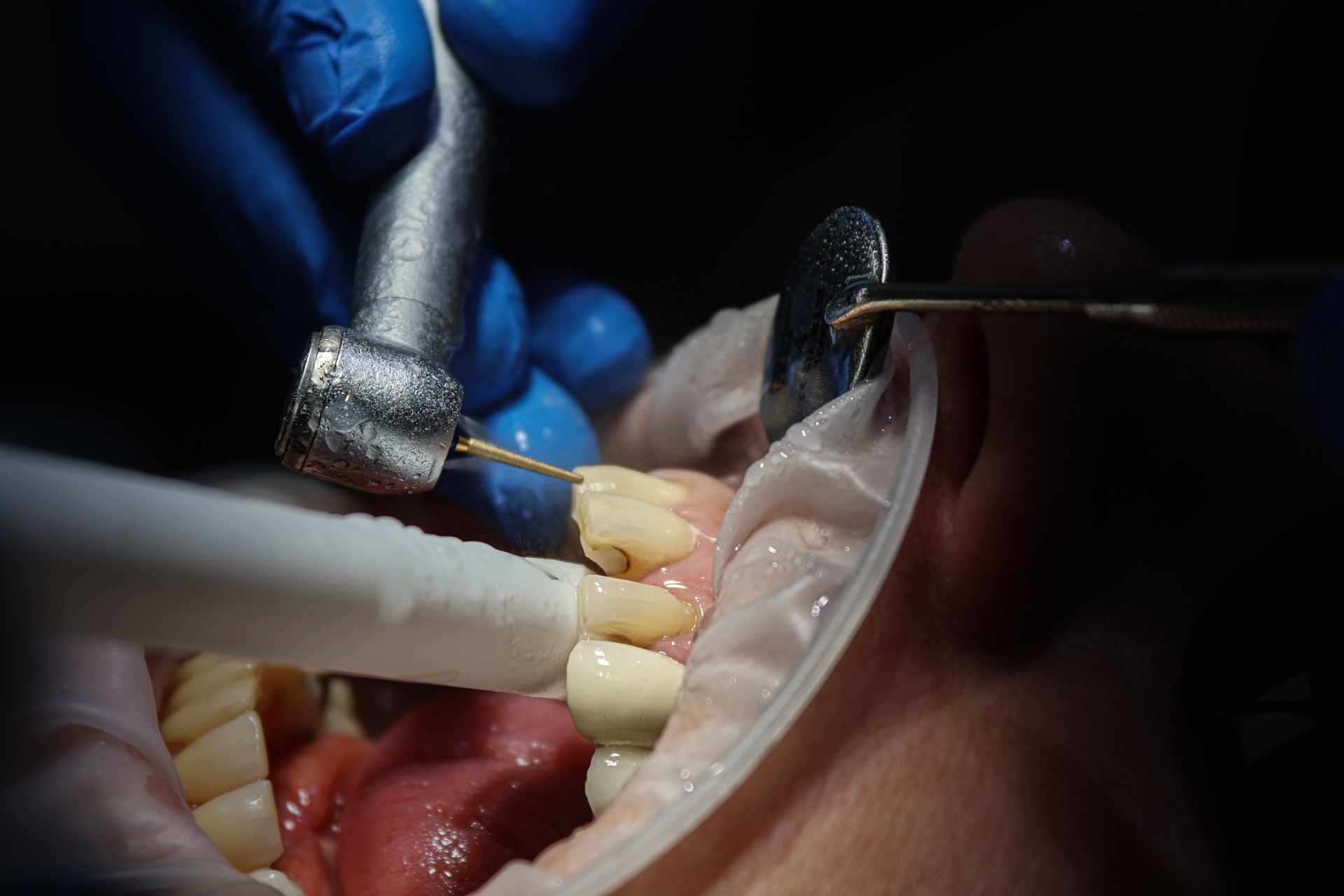 Porcelain-veneers-cosmetic-dentistry-merseyside.jpg