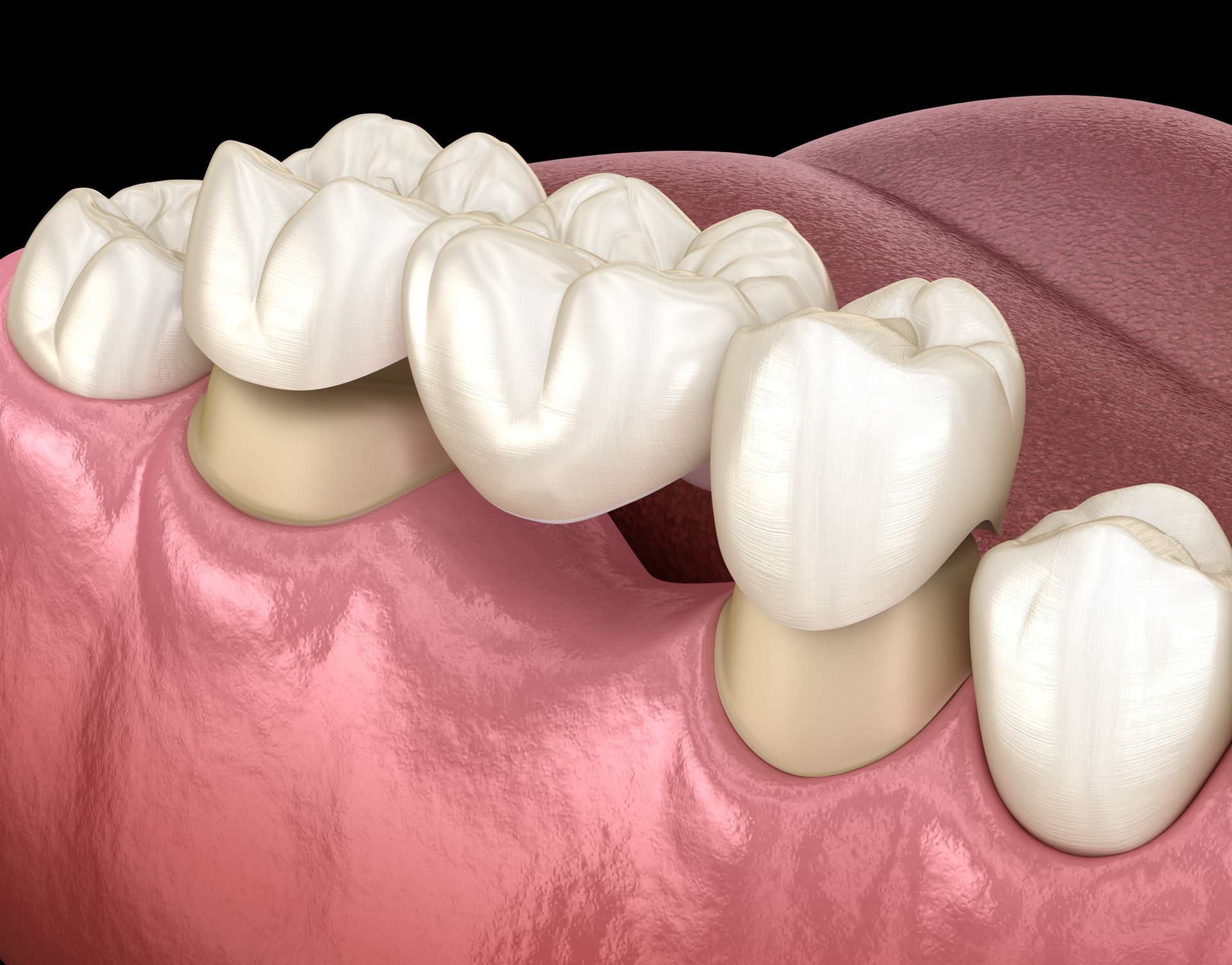 dental bridges in newton-le-willows, Merseyside, replacing missing teeth