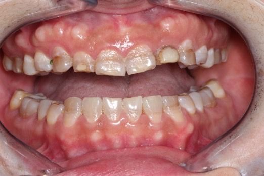 A close up of a person 's mouth with worn down and chipped edges, and erosion and tooth decay. 
