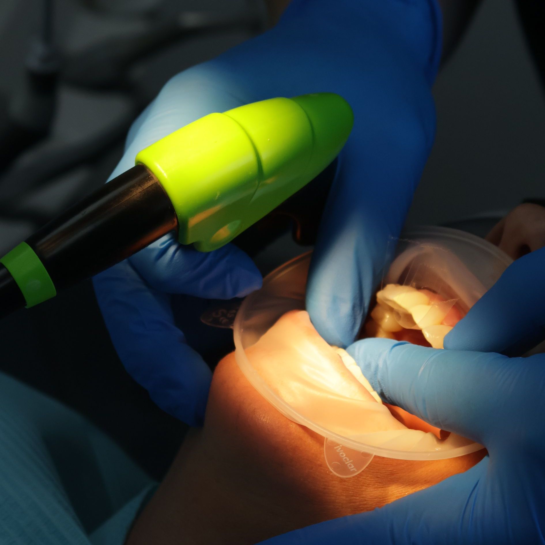 Newton Dental cosmetic dentistry – composite bonding for a confident smile.