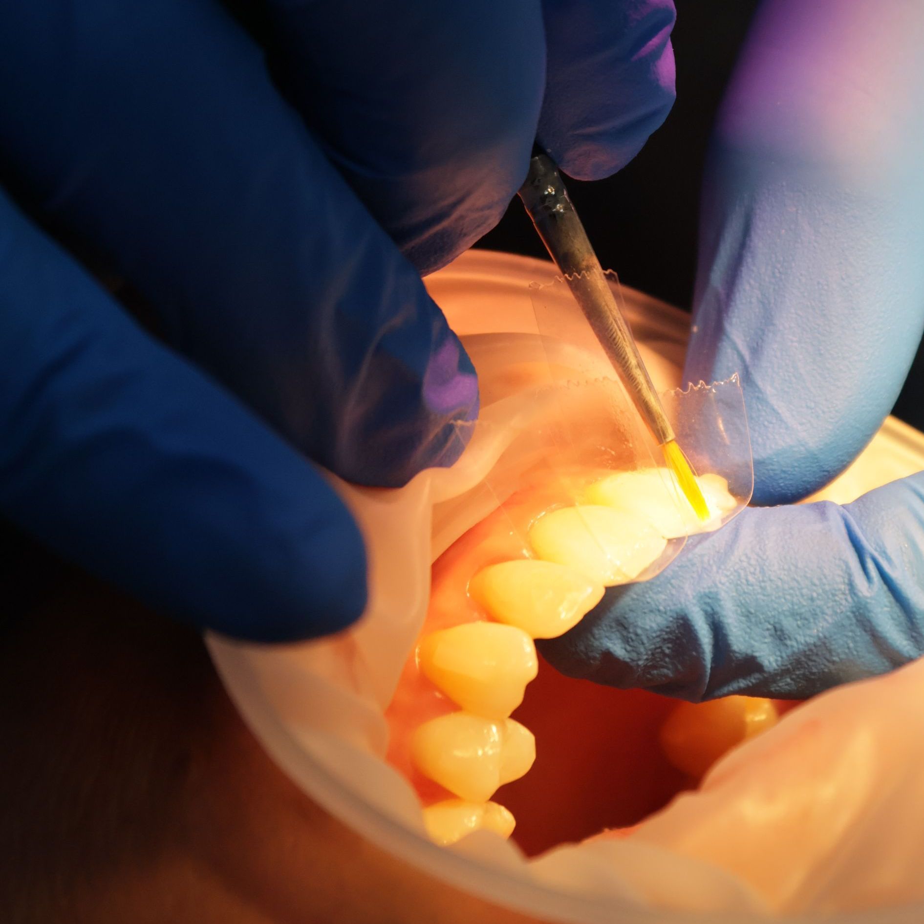 Close-up of composite bonding being applied to teeth at Newton Dental.