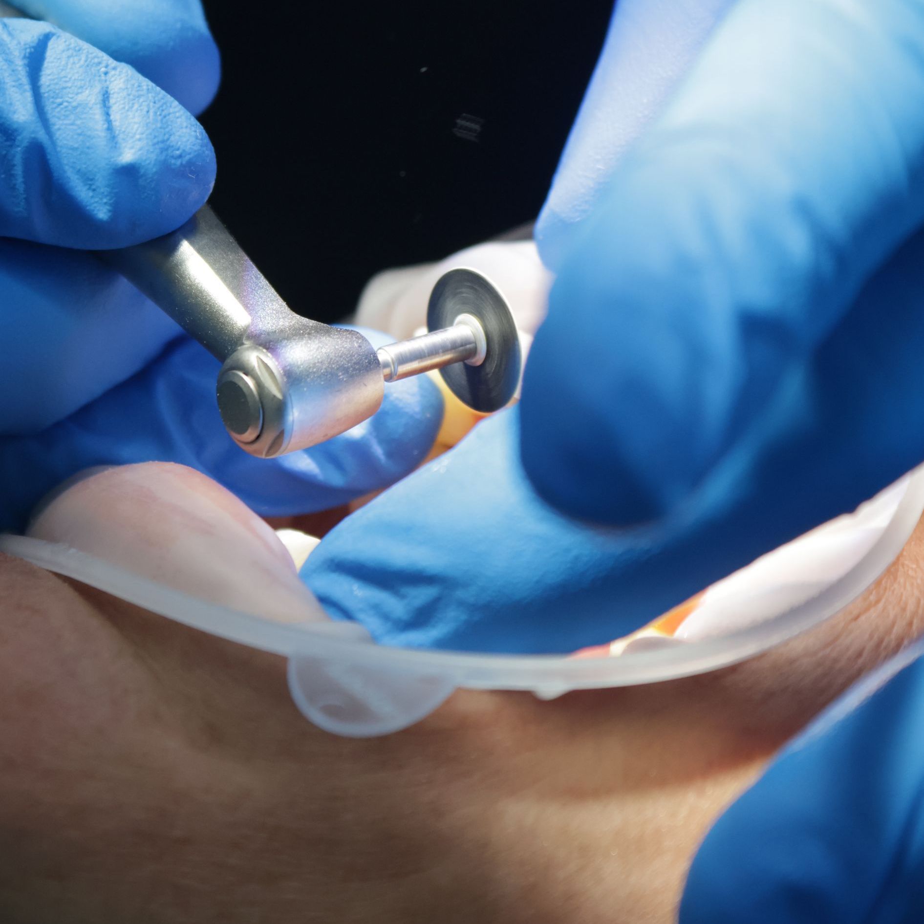 Dentist shaping and polishing composite bonding material for natural-looking teeth.