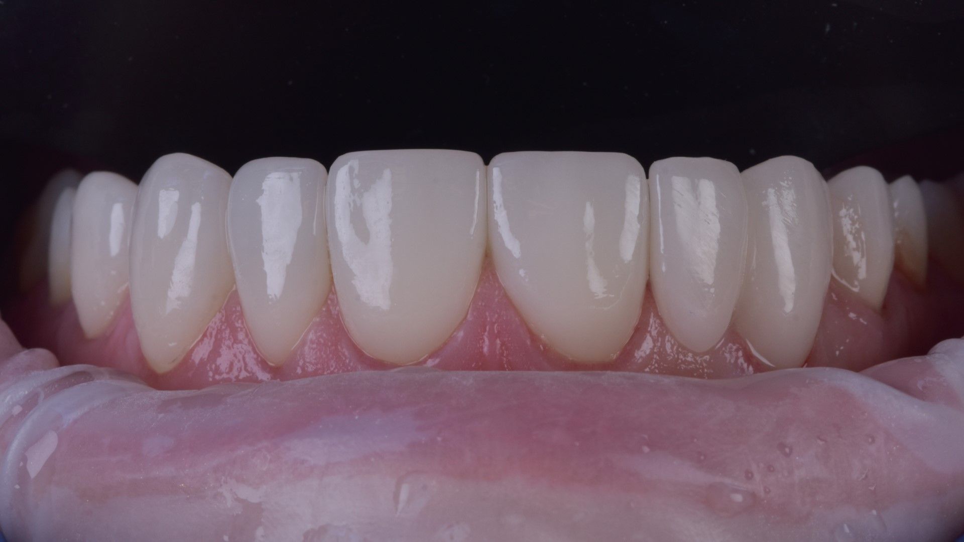Smile transformation with composite bonding at Newton Dental Newton-le-Willows
