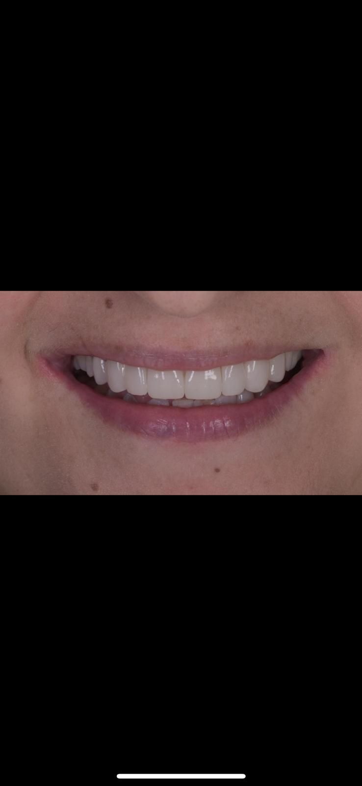 A close up of a woman 's smile with white teeth. The woman has had composite bonding and teeth whitening. 