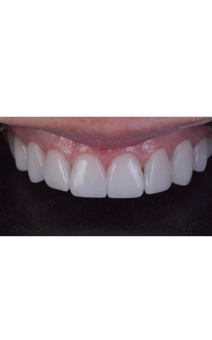 A close up of a person 's teeth with porcelain veneers. A white and healthy smile
