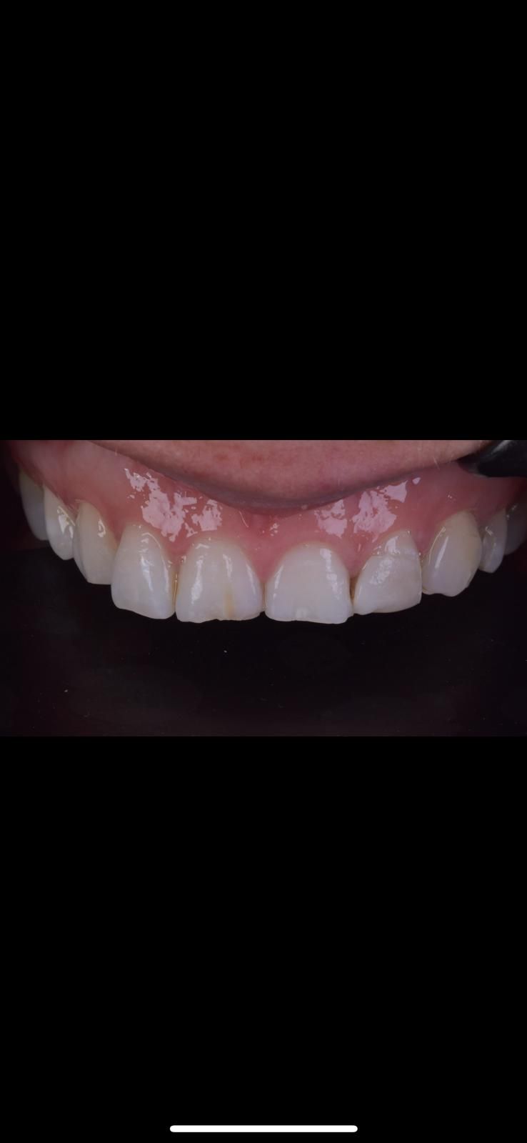 A close up of a person 's teeth with a black background. Chipped and worn teeth. 