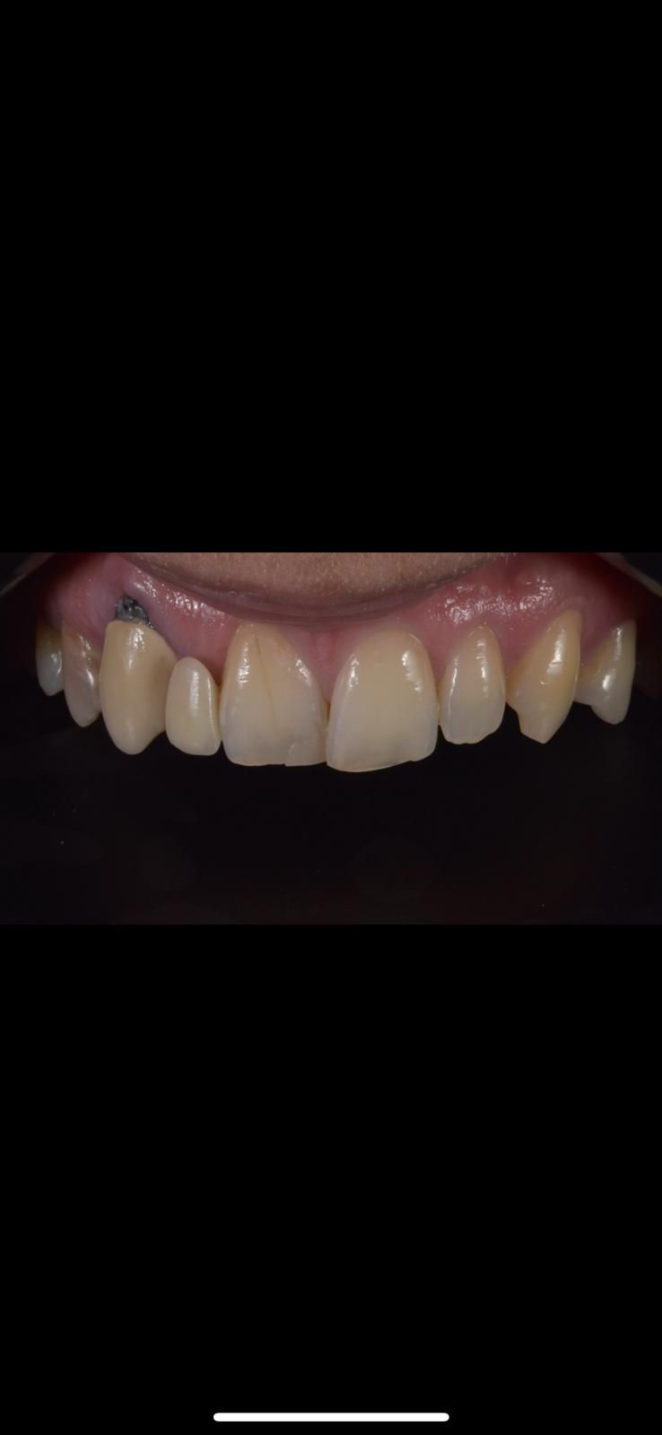 A close up of a person 's teeth, who has gum recession and misaligned teeth. 