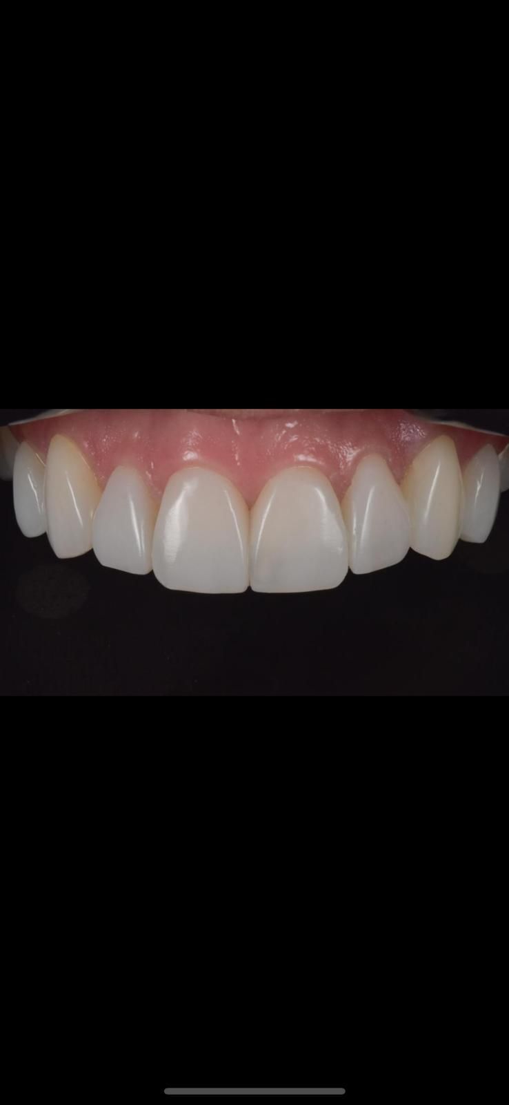 A close up of a person 's straight and white teeth. Person has had teeth whitening and composite bonding. 