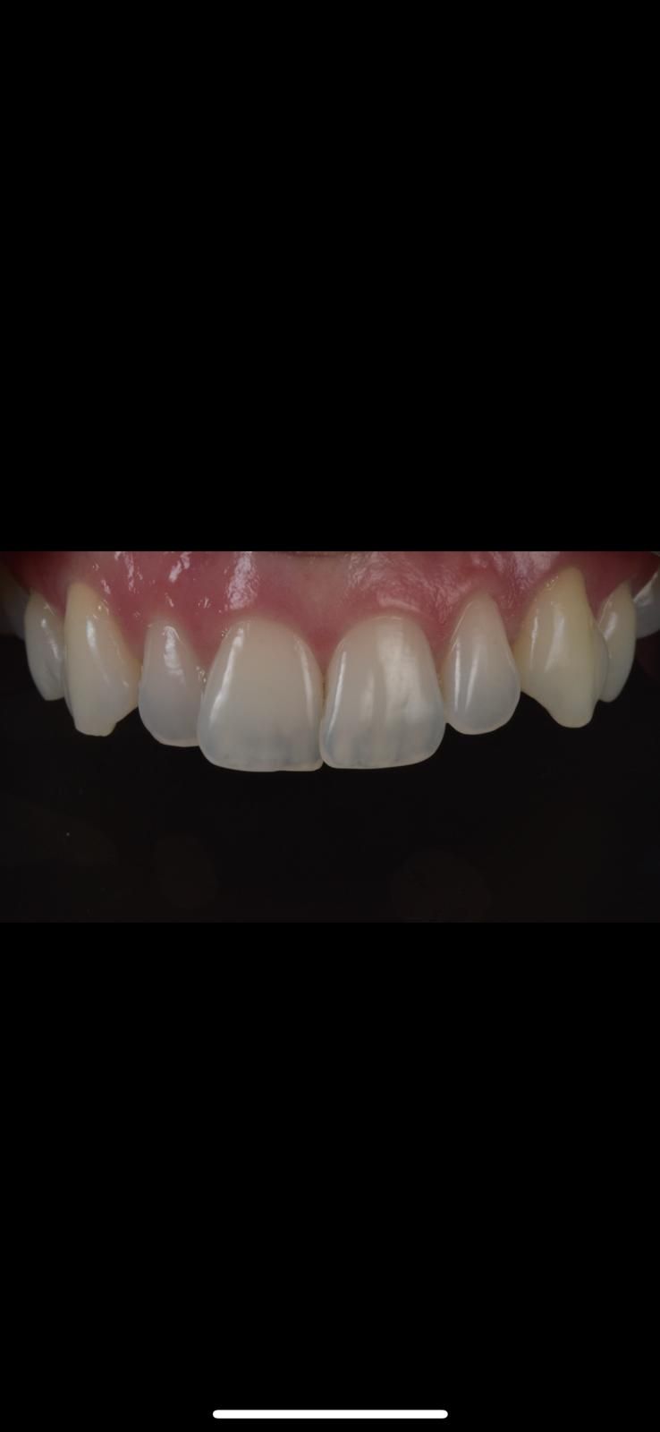 A close up of a person 's teeth on a black background. Misaligned and crooked smile. 