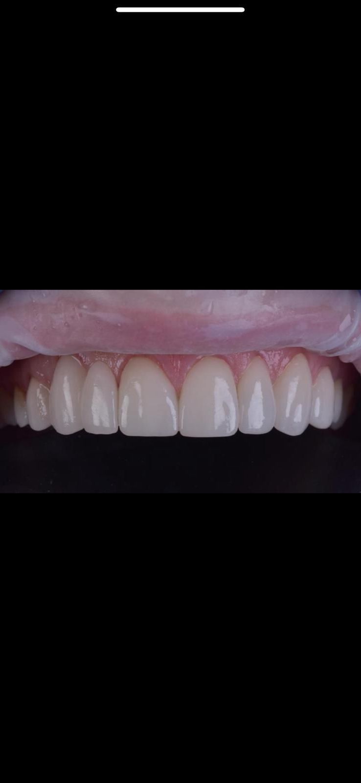 A close up of a person 's teeth on a black background. Dental crowns and dental veneers has been performed. 