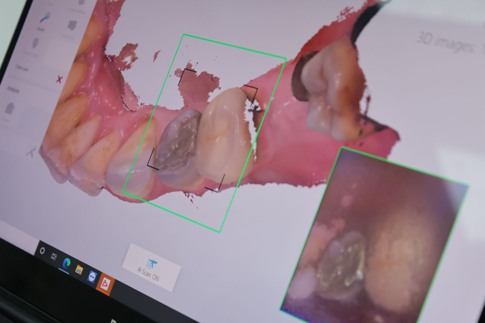 A digital intra oral scan of a patients teeth, showing all of the dental anatomy.