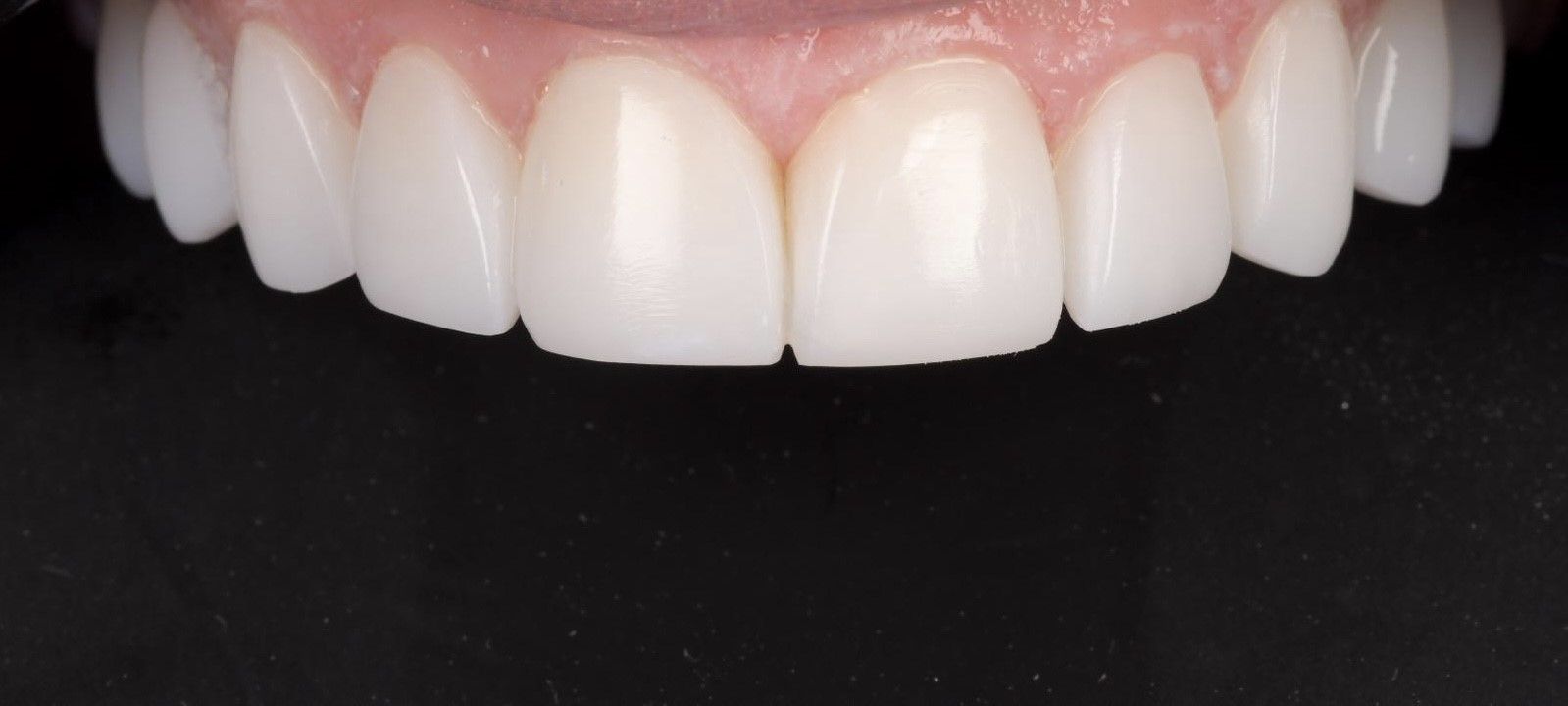 A close up of a person 's teeth on a black background. Composite Bonding on the teeth, and teeth whitening 