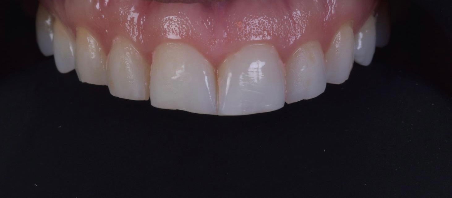 A close up of a person 's teeth on a black background. Patient has some worn down and chipped teeth.