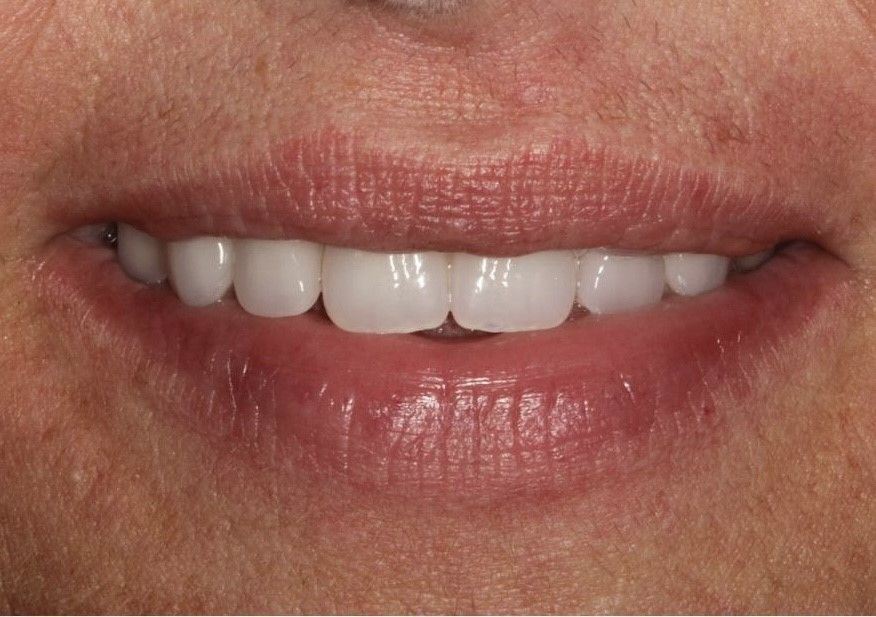 A close up of a woman 's mouth with white teeth. Teeth whitening and dental implants have been performed 
