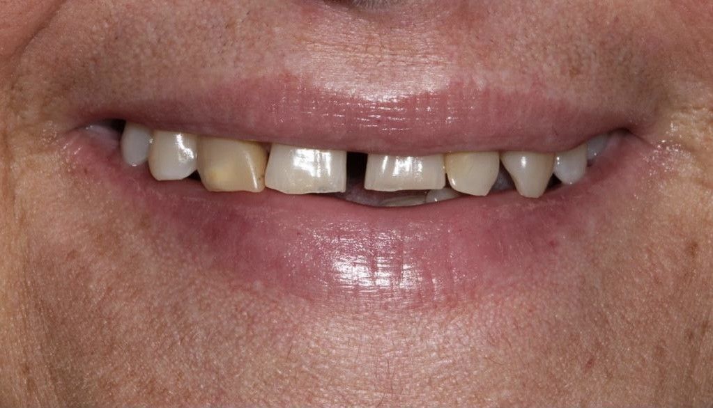 A close up of a person 's mouth with missing teeth.