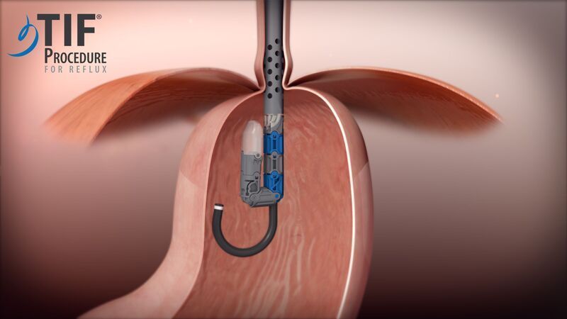 Acid reflux and Gerd Acid reflux and Gerd
