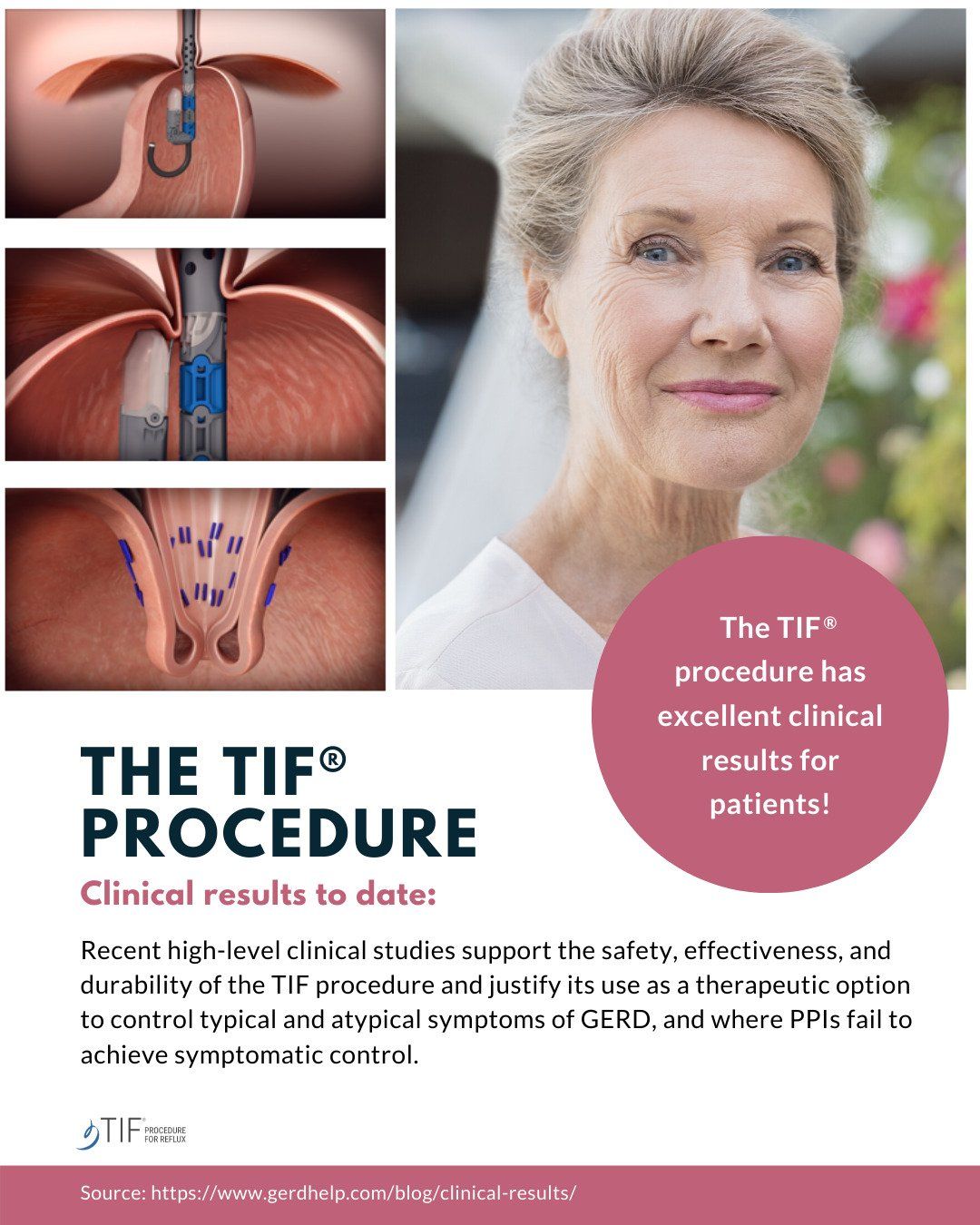 TIF Procedure TIF Procedure