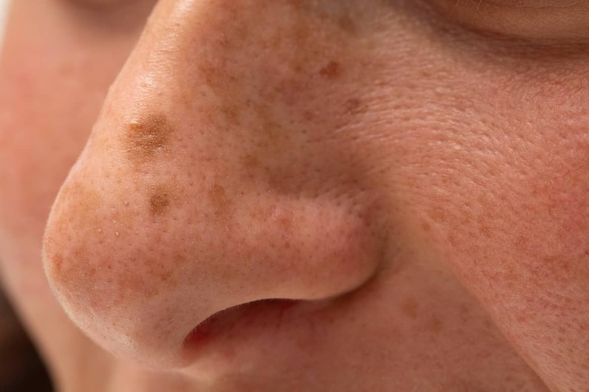 Skin Cancer symptoms 1